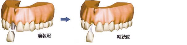 クラウン（被せ物）